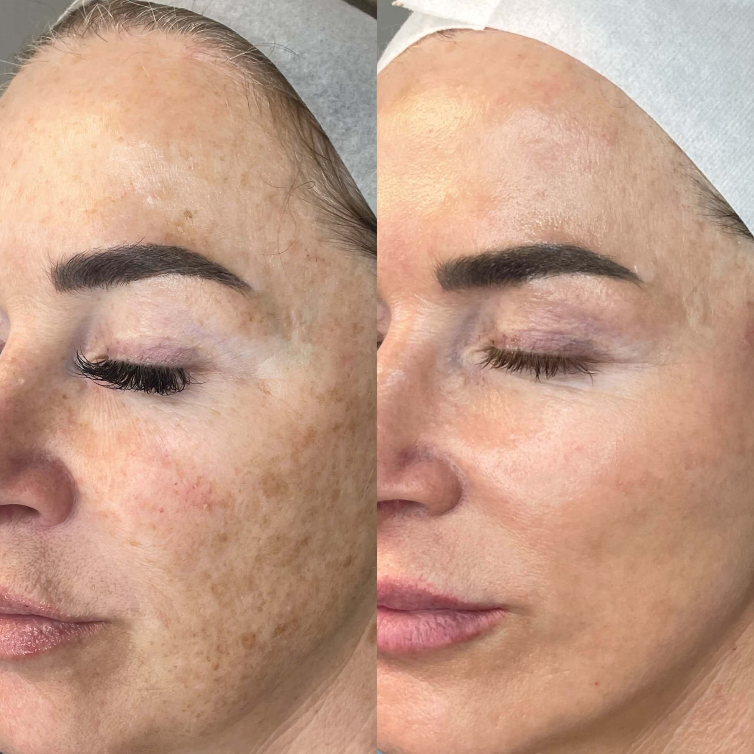 MOXI Laser Skin Rejuvenation course of 2 (save up to €801)