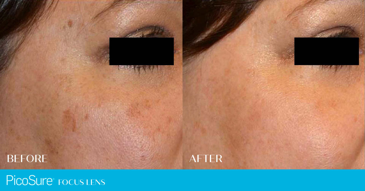 Picosure Laser Skin Rejuvenation Single Session