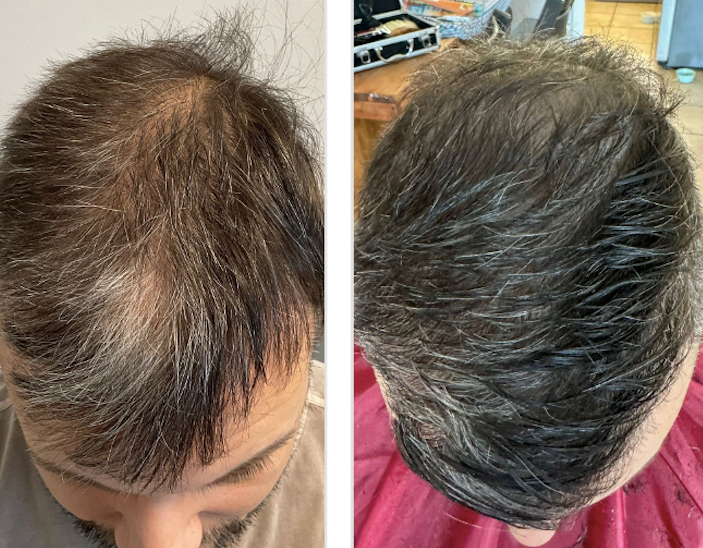 PRP with Exosomes for face or scalp course of 2 (save €451)