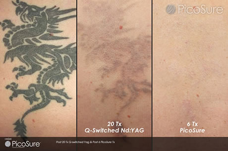 Picosure Laser Tattoo Removal (save up to €501)