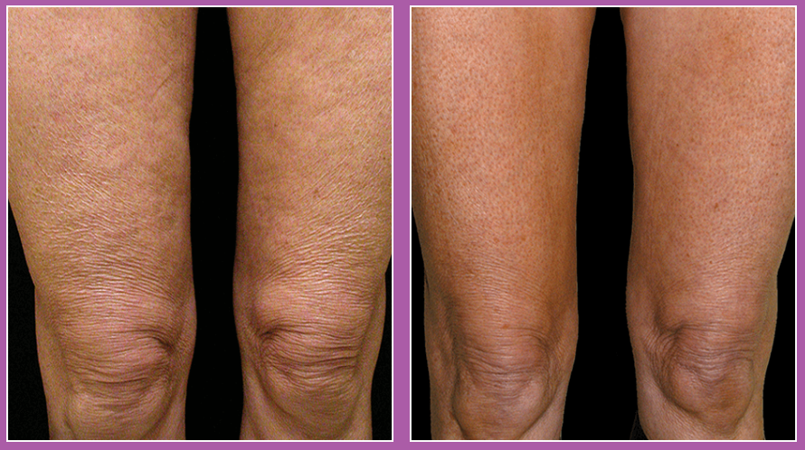 Thermage FLX RF Anti-Ageing Skin Tightening Treatment (save up to €601)