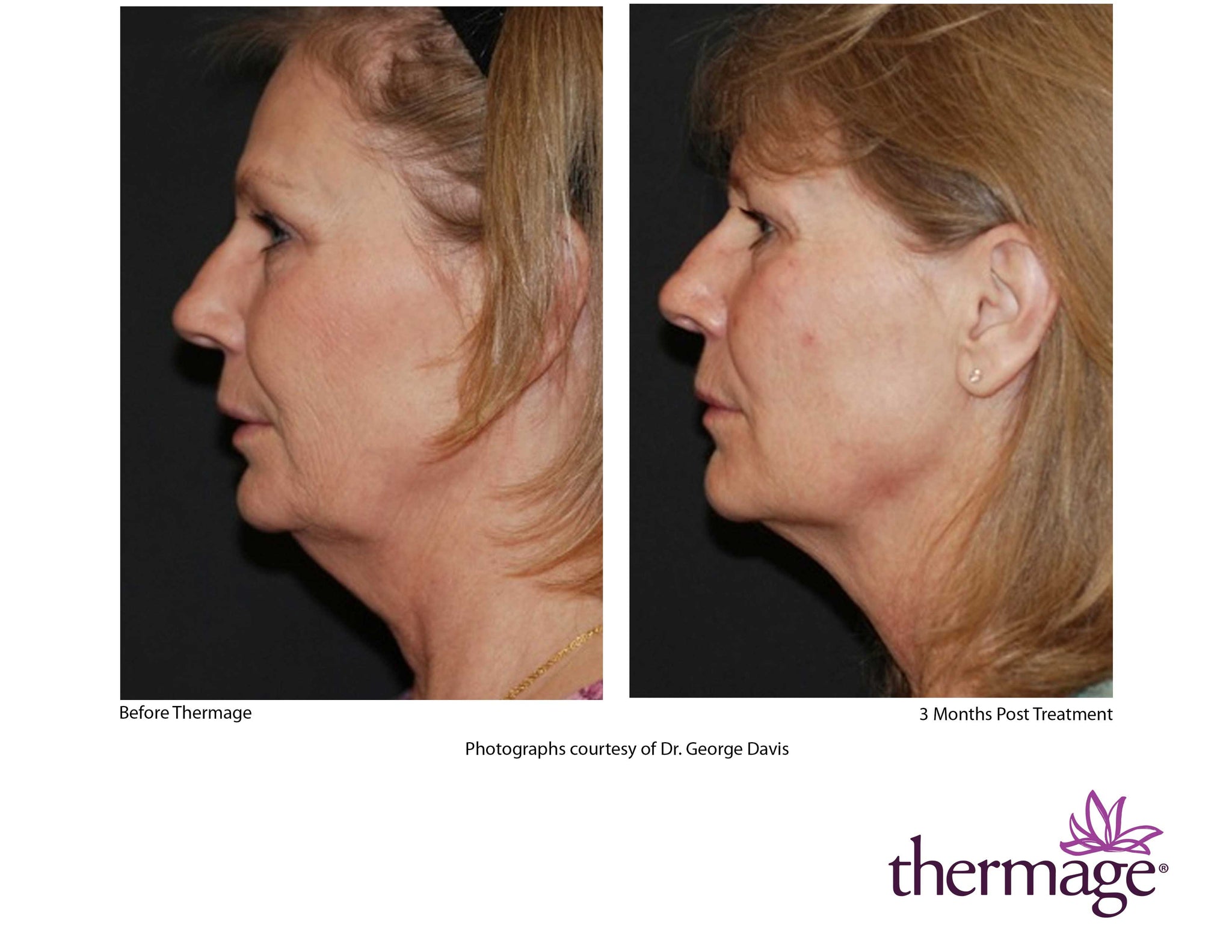 Thermage FLX RF Anti-Ageing Skin Tightening Treatment (save up to €601)