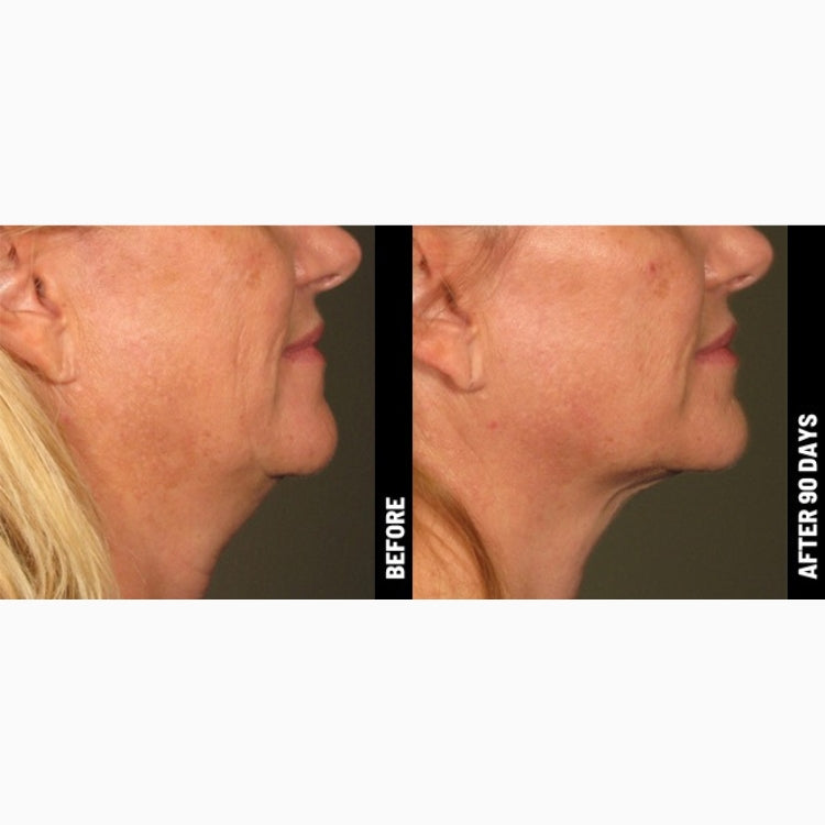 Ultherapy Non-Surgical Face Lift & Skin Tightening (save up to €801)