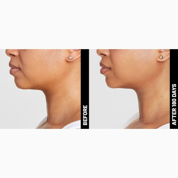 Ultherapy Non-Surgical Face Lift & Skin Tightening (save up to €801)