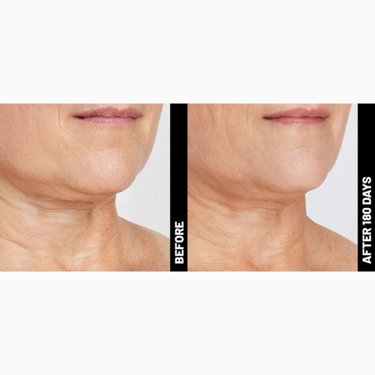Ultherapy Non-Surgical Face Lift & Skin Tightening (save up to €801)