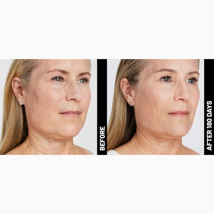 Ultherapy Non-Surgical Face Lift & Skin Tightening (save up to €801)