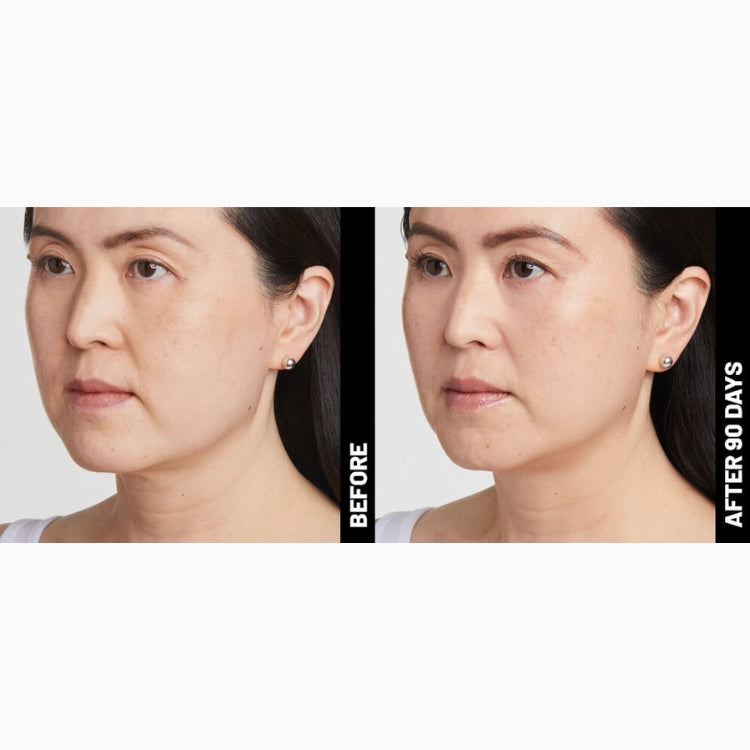 Ultherapy Non-Surgical Face Lift & Skin Tightening (save up to €801)