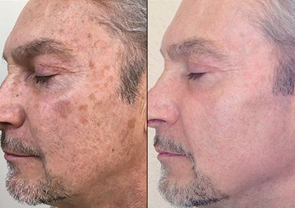 HALO Laser Skin Resurfacing for full face or neck