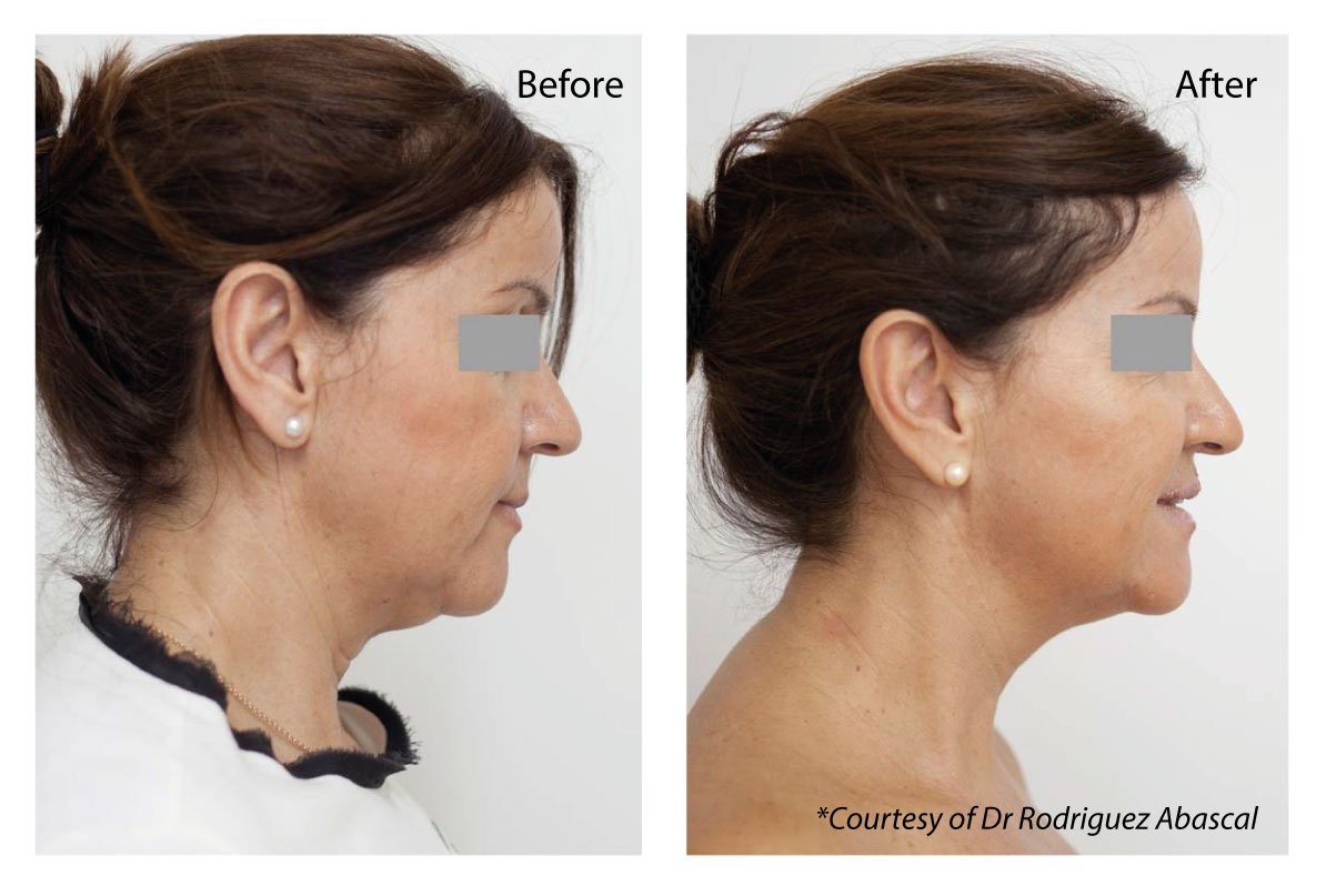 Profhilo Hyaluronic Acid Injections Full Face & Neck Two Treatments