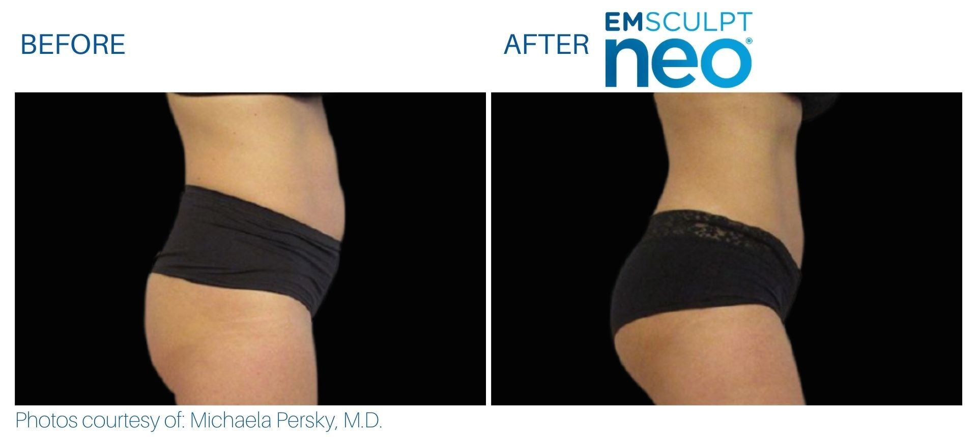 EmSculpt NEO Muscle Building & Fat Burning course of 5 (save €751)