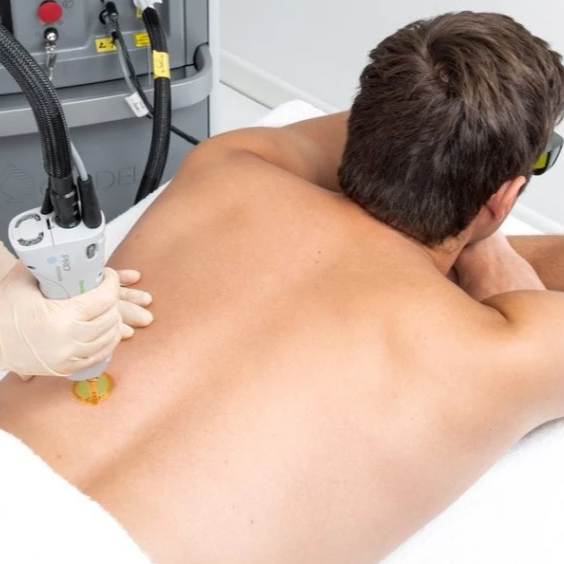 Laser Hair Removal for Men Full Back & Shoulders (as low as €99.90 per session)