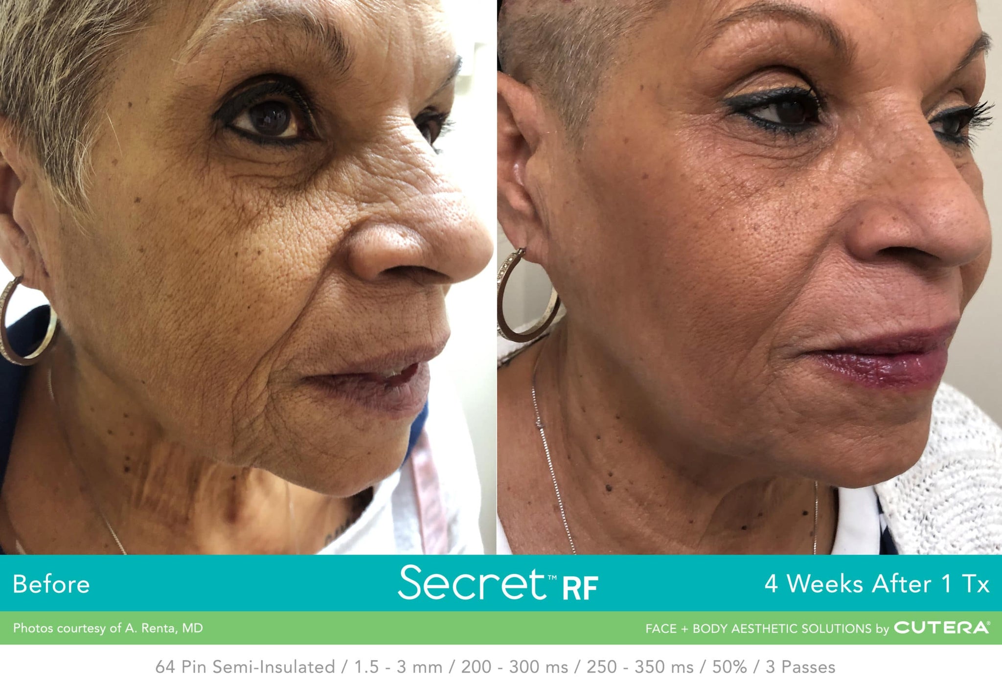 Cutera Secret RF +Microneedling with complimentary choice of skin booster (save €351)