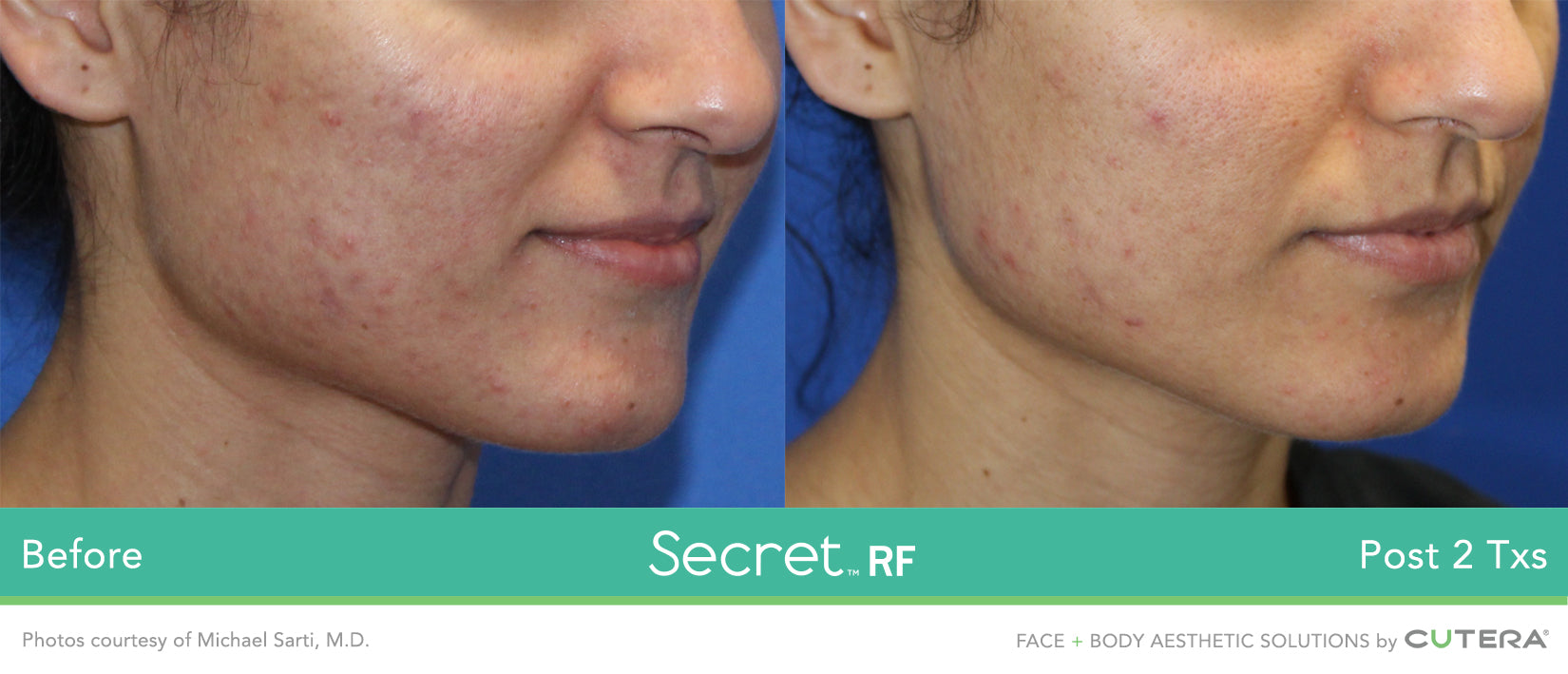 Cutera Secret RF +Microneedling with complimentary choice of skin booster (save €351)