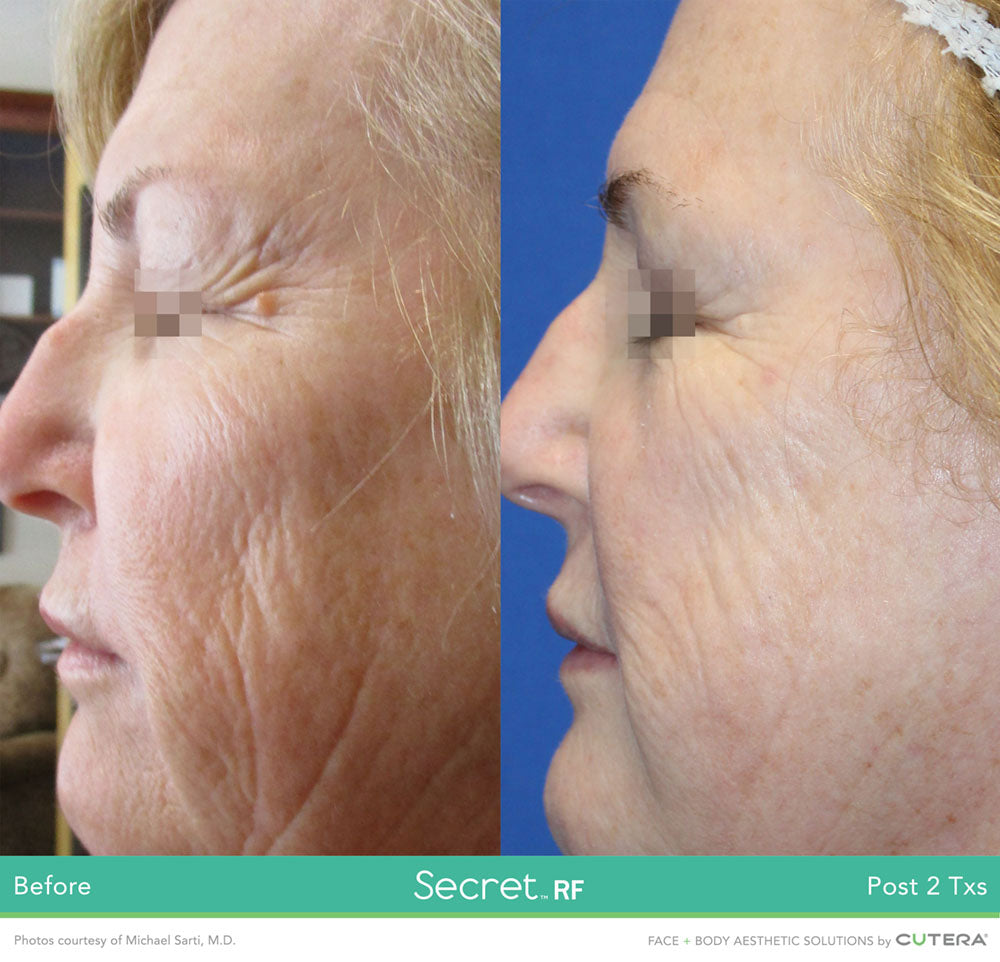 Cutera Secret RF +Microneedling with complimentary choice of skin booster (save €351)