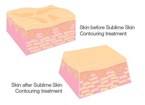 Sublative Skin Resurfacing course of 3 (Save €100)