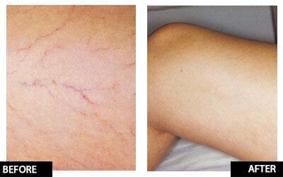 Laser thread vein reduction for small/medium area legs course of 3+1 FREE (save €251)