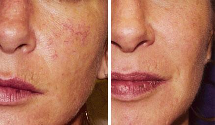 Laser thread vein removal for full face (any areas to be treated on face)